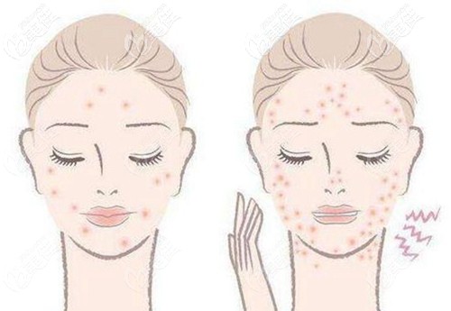 皮膚出現(xiàn)痘痘