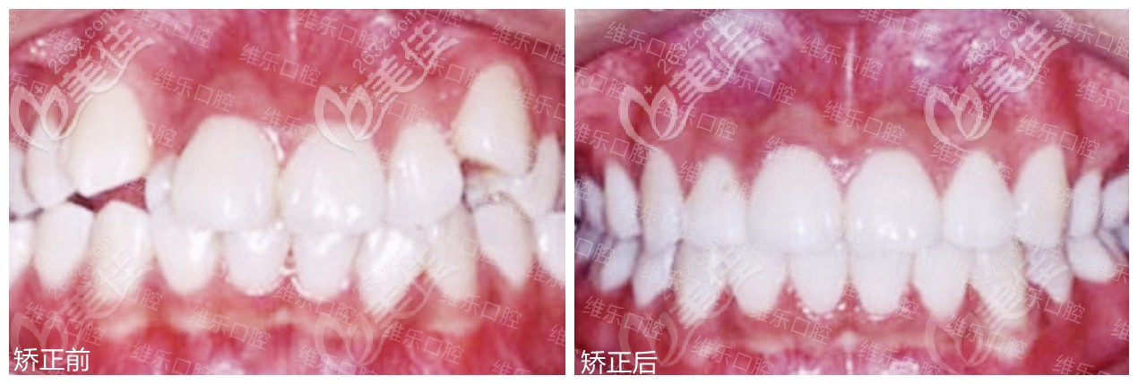 在福州維樂口腔矯正前后對比