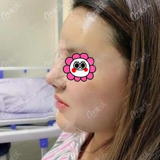 鼻綜合術(shù)后第1天效果照 鼻綜合術(shù)后第1天效果照