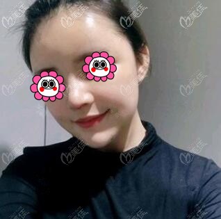 鼻綜合術(shù)后第8天 鼻綜合術(shù)后第8天