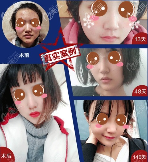 武漢美基元射極峰膨體鼻修復案例