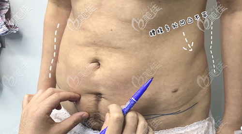 腰腹環(huán)吸凹凸不平圖片 腰腹環(huán)吸凹凸不平圖片