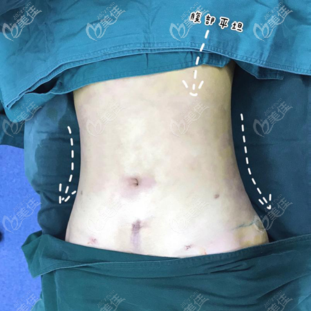 親測鄭州王俊民的腰腹吸脂修復(fù)效果,凹凸不平的小肚子變的平坦了