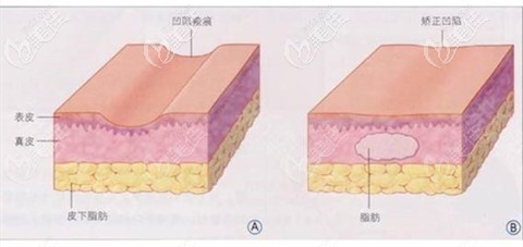 腰腹環(huán)吸后凹凸不平修復 腰腹環(huán)吸后凹凸不平修復