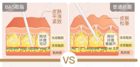 醫(yī)院吸脂優(yōu)勢(shì) 醫(yī)院吸脂優(yōu)勢(shì)