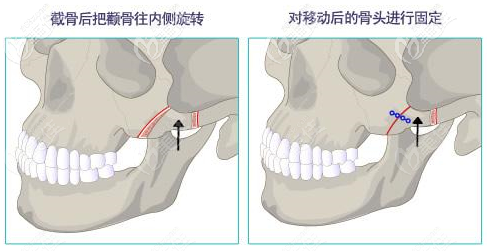 顴骨內(nèi)推手術(shù)過程圖解