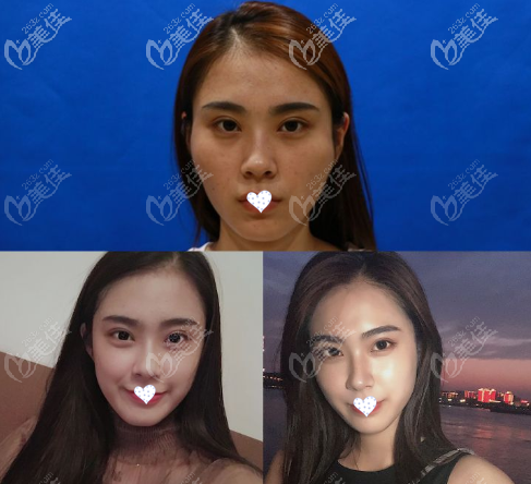 顴骨內(nèi)推7mm效果圖