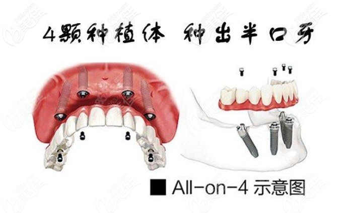allon4半口種植牙示意圖 allon4半口種植牙示意圖