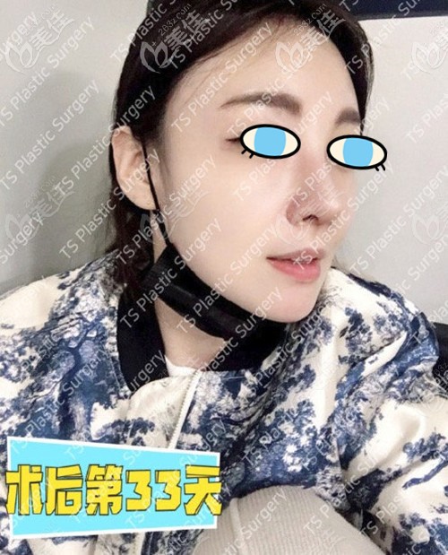 鼻修復術后一個月效果