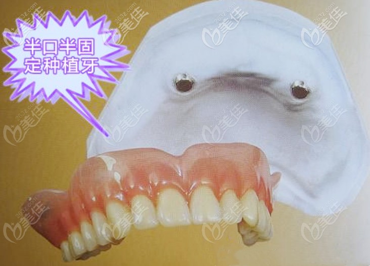 半口半固定種植牙 半口半固定種植牙