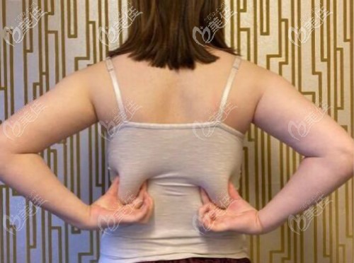 福州美貝爾背部吸脂術(shù)前照片 福州美貝爾背部吸脂術(shù)前照片