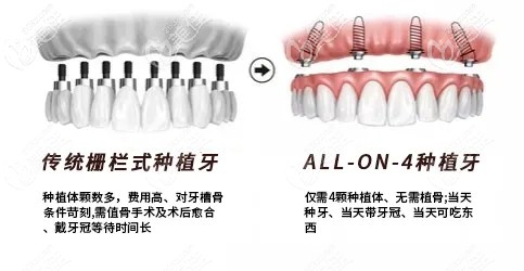 一日得種植牙技術(shù)圖示