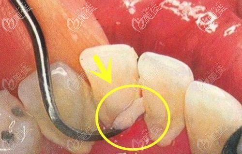 牙結(jié)石過(guò)多導(dǎo)致牙齦萎縮