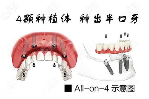 all-on-4種植牙技術(shù)