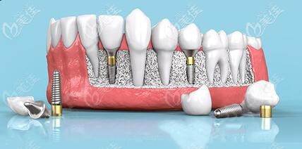 瑞典諾貝爾種植體類型多，適應(yīng)癥廣泛