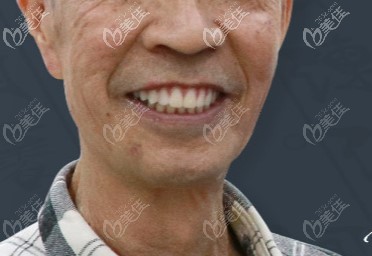 這就系做了滿口種植牙后的郭老