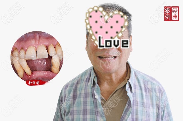 重度牙周炎的黎叔叔體驗(yàn)了即刻負(fù)重種植牙