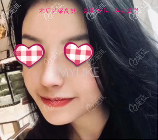 要想知道曾熬醫(yī)生做鼻子怎么樣，看真人案例的評價才靠譜啊