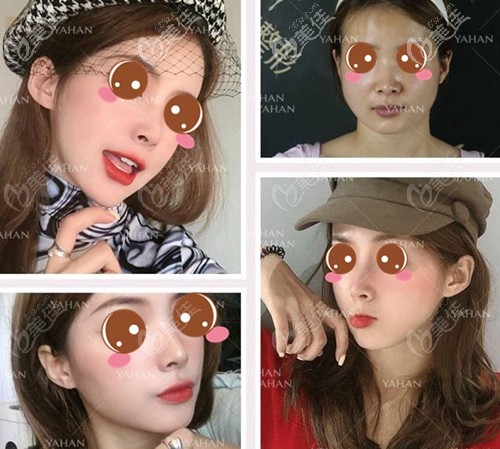 武漢亞韓顴骨下頜角案例