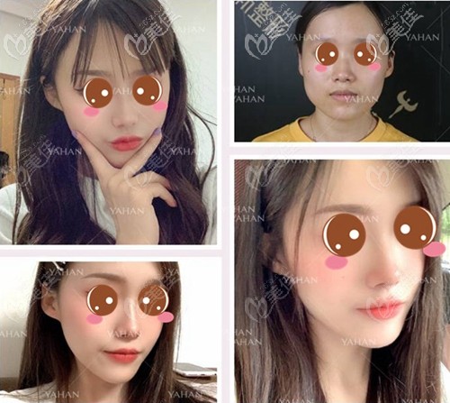 武漢亞韓V-line瓜子臉案例