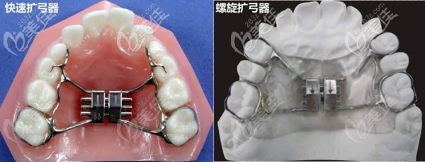 擴弓器矯正方式