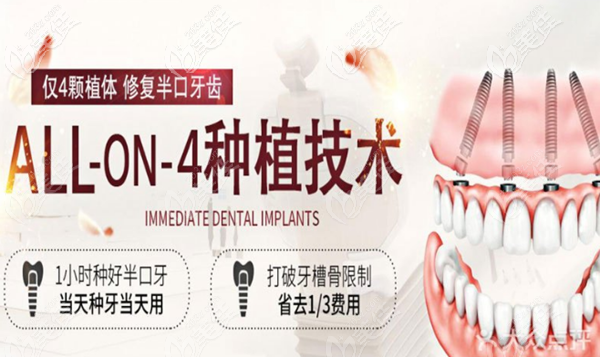 咸陽海濤口腔ALL-ON-4種植牙