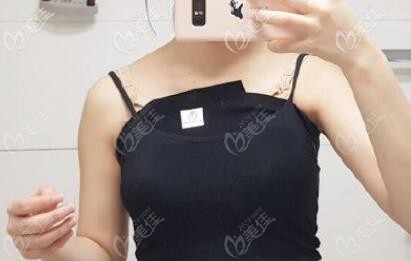 我奧美定豐胸18年取出后的樣子 我奧美定豐胸18年取出后的樣子