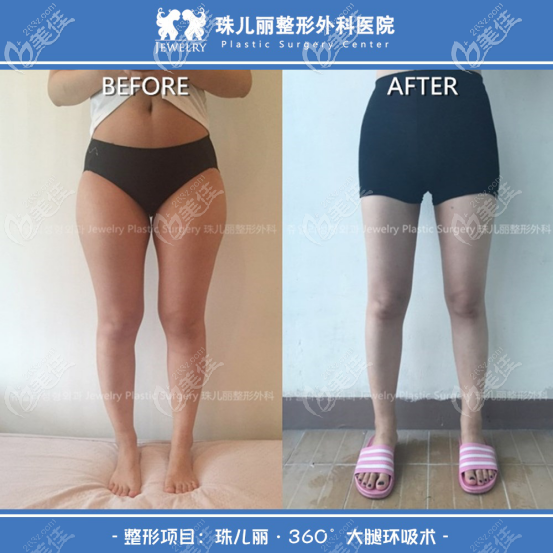 韓國(guó)珠兒麗吸脂大腿小腿吸脂案例 韓國(guó)珠兒麗吸脂大腿小腿吸脂案例