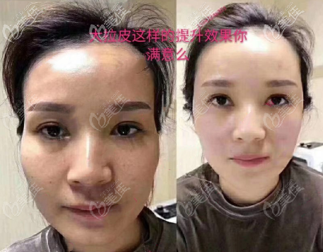 韓國拉菲安面部大拉皮除皺手術(shù)50天照片 韓國拉菲安面部大拉皮除皺手術(shù)50天照片