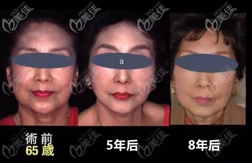 拉本是韓國做面部大拉皮除皺好的醫(yī)院不是隨便說說，有案例為證