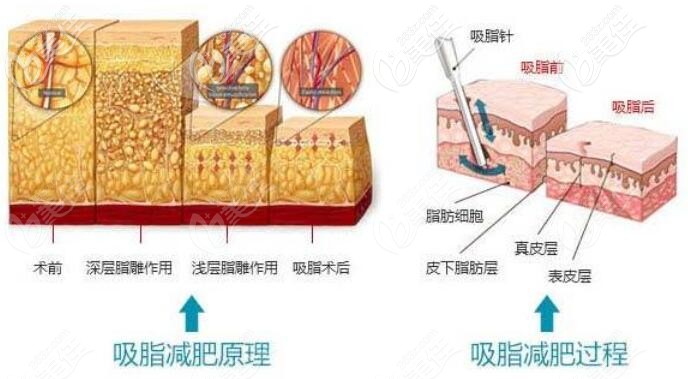吸脂減肥原理與過程 吸脂減肥原理與過程