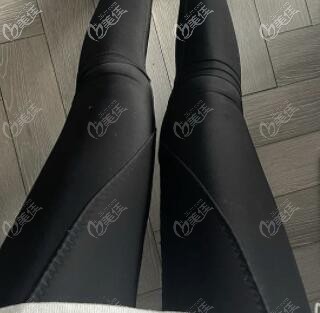 大腿抽脂術(shù)后10天照 大腿抽脂術(shù)后10天照