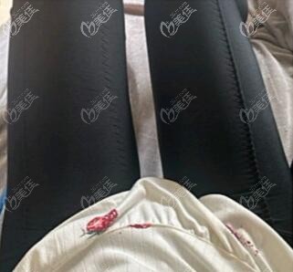吸脂瘦大腿術(shù)后25天照 吸脂瘦大腿術(shù)后25天照