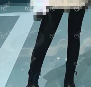 沒想到在沈陽匯美人醫(yī)療美容做大腿360°環(huán)形吸脂1個半月后腿圍竟瘦了近6厘米！