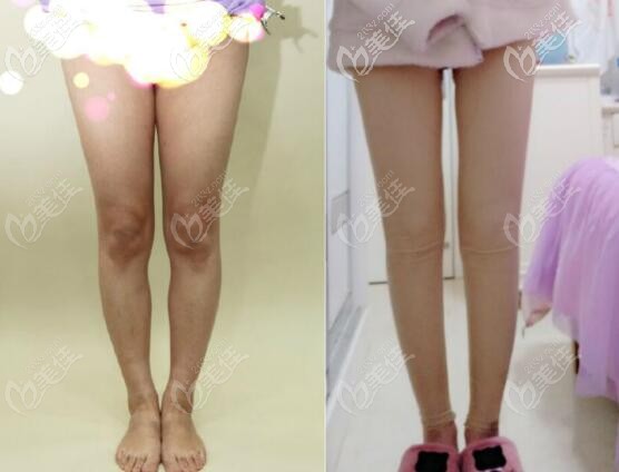 北京達(dá)美如藝羅圈腿矯正案例兩個(gè)月真實(shí)效果對(duì)比圖 北京達(dá)美如藝羅圈腿矯正案例兩個(gè)月真實(shí)效果對(duì)比圖