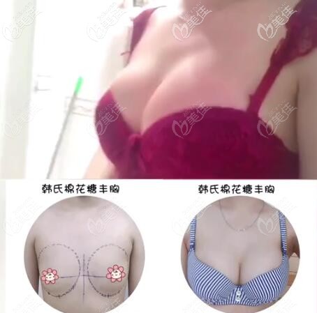韓嘯棉花糖豐胸真實(shí)案例效果對(duì)比圖 韓嘯棉花糖豐胸真實(shí)案例效果對(duì)比圖