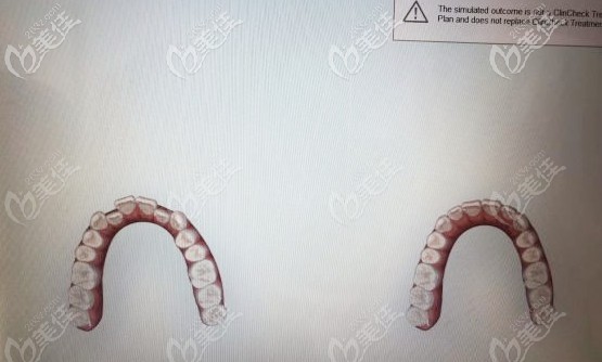 口掃可提前預(yù)知矯正<span style=