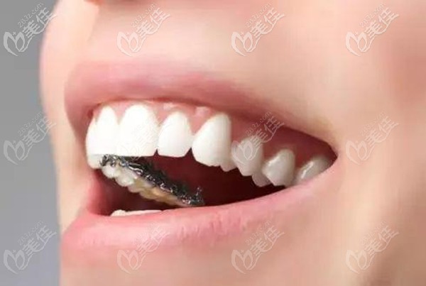 舌側(cè)隱形矯正圖