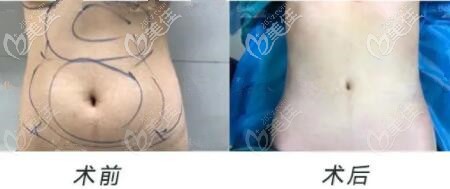 維密脂雕瘦腰腹真人前后對比照
