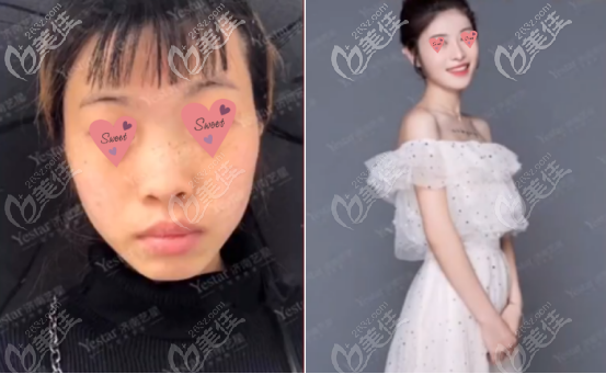 四號求美者的案例圖片以及真實(shí)評價