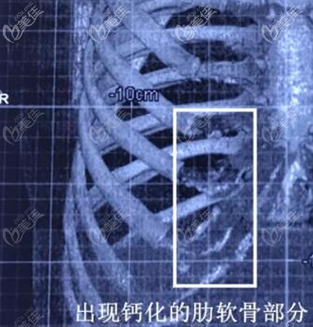 肋軟骨鈣化的輕重程度 肋軟骨鈣化的輕重程度