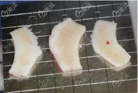 肋軟骨點狀鈣化圖片 肋軟骨點狀鈣化圖片