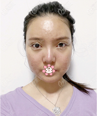 分享我找廣東美恩<!--<i data=20240703-sp></i>-->做磨骨的原因 分享我找廣東美恩<!--<i data=20240703-sp></i>-->做磨骨的原因