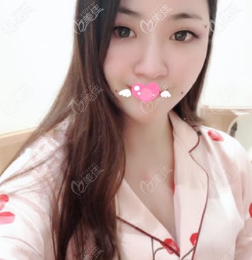 面部脂肪填充第3天的恢復(fù)圖