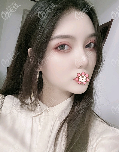 廣州做磨骨手術(shù)怎么樣?炫耀一下我找醫(yī)生做的下頜角術(shù)后效果