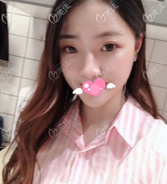 <!--<i data=20240703-sp></i>-->面部脂肪填充第7天<span style=