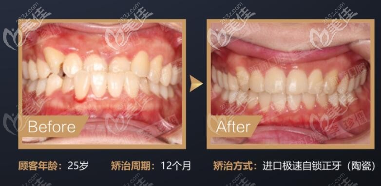 顧客矯正前后的口內(nèi)真是圖片 顧客矯正前后的口內(nèi)真是圖片