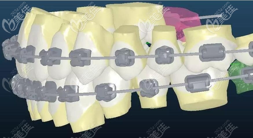 金屬自鎖托槽矯正展示圖 金屬自鎖托槽矯正展示圖