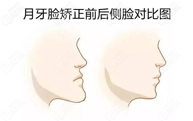 月牙臉矯正前后對比 月牙臉矯正前后對比