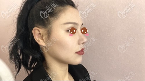 耳軟骨隆鼻失敗4個(gè)月后來做了修復(fù)，術(shù)后鼻尖一改之前又大又圓之態(tài)